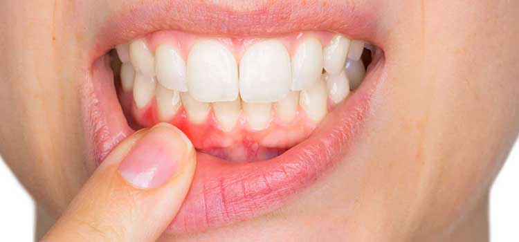 مفید برای دندان و لثه در مقاله خواص عسل مانوکا