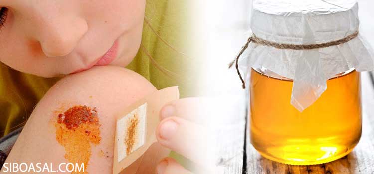 عسل برای درمان سوختگی